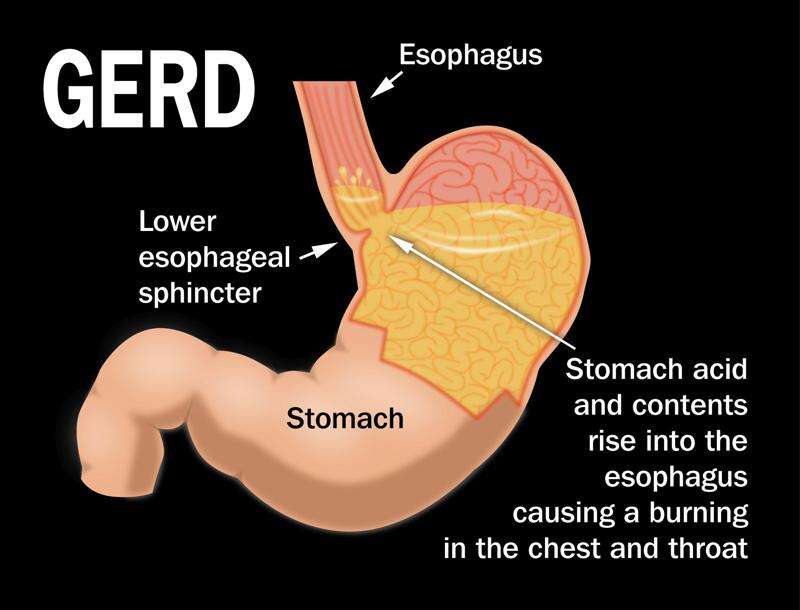 Burning Sensation Sour Stomach Chest Pain You May Have Gerd Times News Online